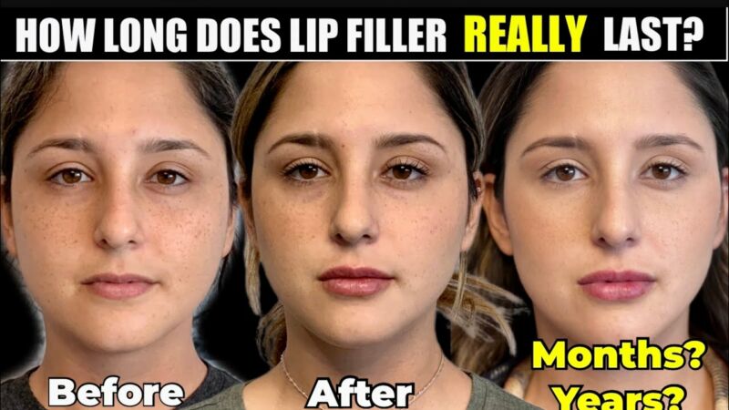 how often do you need lip fillers topped up 1 Tp5 eLMAQ