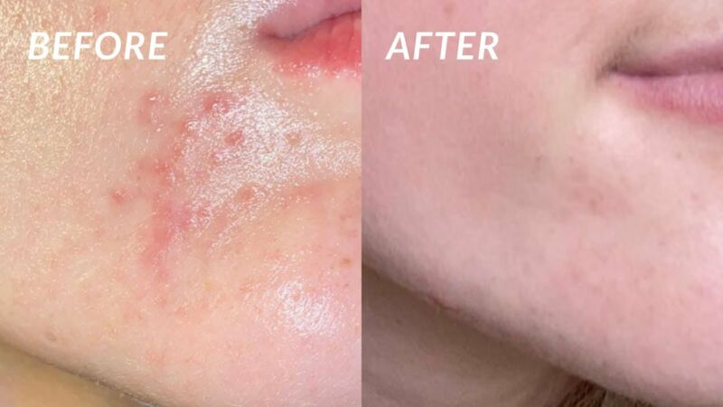 how to get rid of perioral dermatitis overnight zj5Q4qawIt0