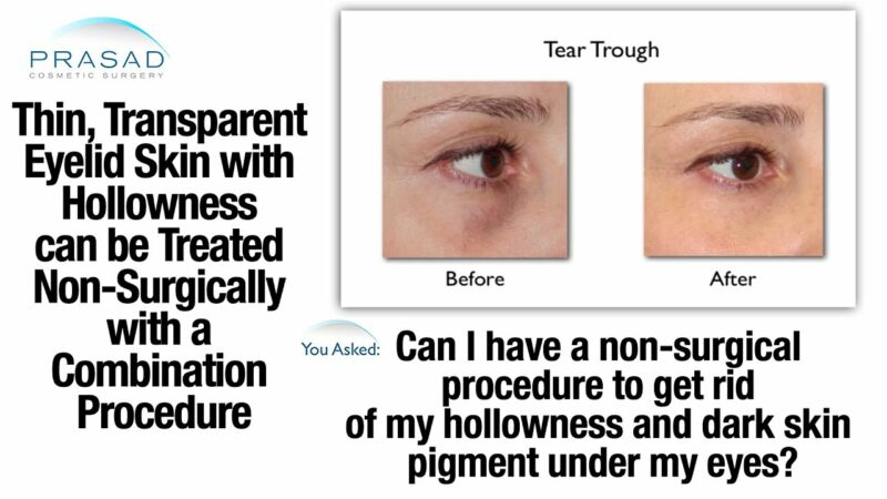 how to thicken skin under eyes 7zg5 CFMdSY